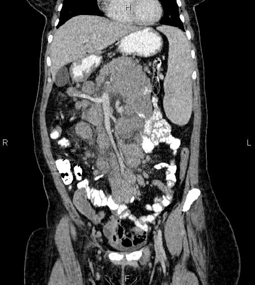 Abdominal lymphoma with sandwich sign (Radiopaedia 84378-99704 Coronal C+ portal venous phase 17).jpg