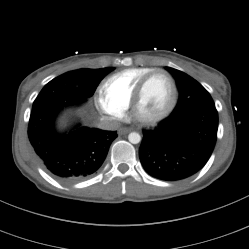 File:Abdominal multi-trauma - devascularised kidney and liver, spleen and pancreatic lacerations (Radiopaedia 34984-36486 Axial C+ arterial phase 63).png