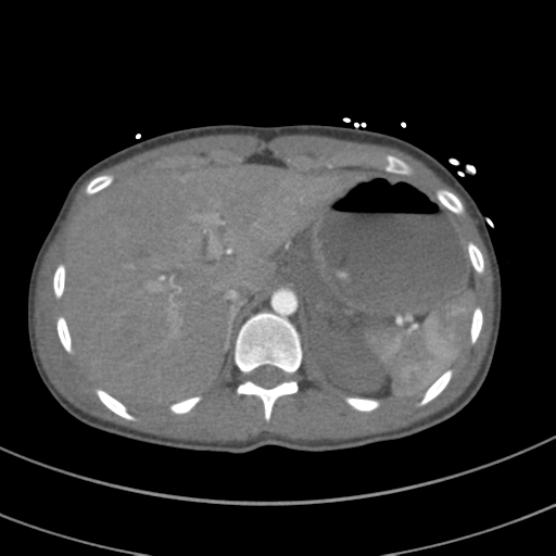 File:Abdominal multi-trauma - devascularised kidney and liver, spleen and pancreatic lacerations (Radiopaedia 34984-36486 Axial C+ arterial phase 84).png