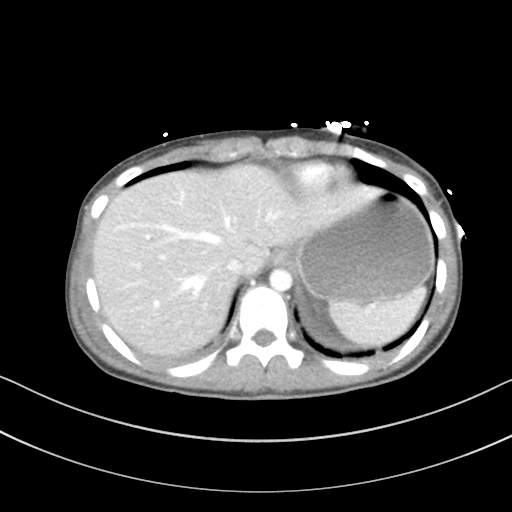 Abdominal multi-trauma - devascularised kidney and liver, spleen and pancreatic lacerations (Radiopaedia 34984-36486 Axial C+ portal venous phase 11).png