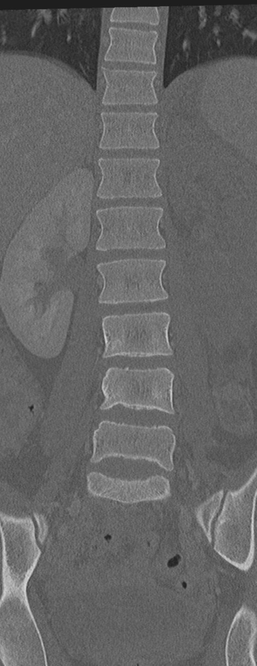 Abdominal multi-trauma - devascularised kidney and liver, spleen and pancreatic lacerations (Radiopaedia 34984-36486 Coronal bone window 31).png