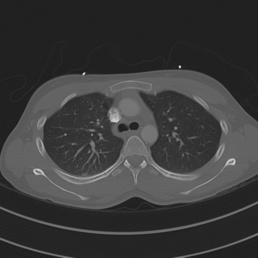 File:Abdominal multi-trauma - devascularised kidney and liver, spleen and pancreatic lacerations (Radiopaedia 34984-36486 I 29).png