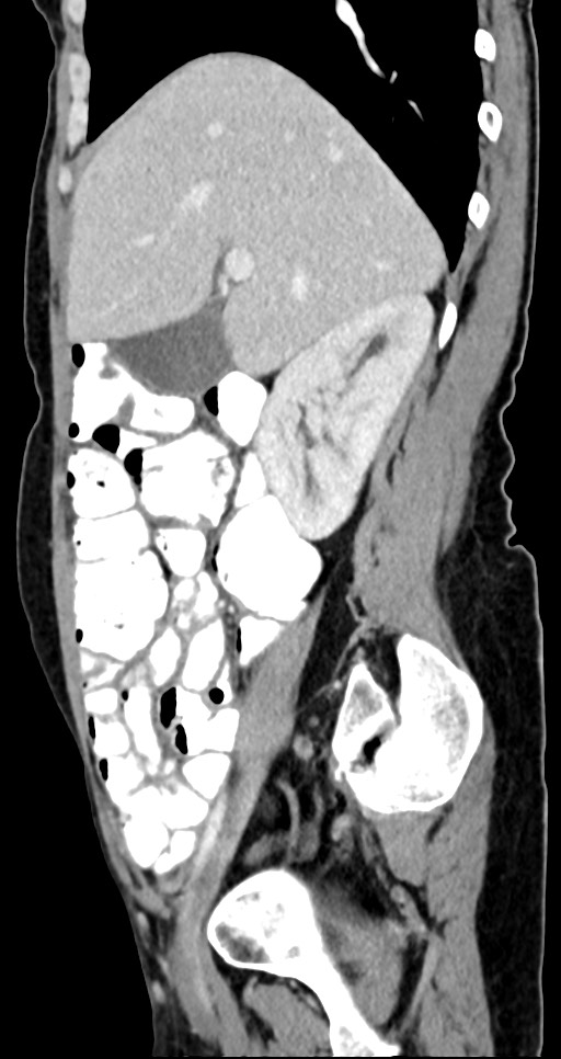 Abdominal wall and retroperitoneal tuberculosis (Radiopaedia 88137-104729 Sagittal C+ portal venous phase 102).jpg