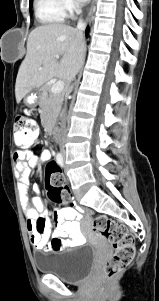 Abdominal wall and retroperitoneal tuberculosis (Radiopaedia 88137-104729 Sagittal C+ portal venous phase 80).jpg