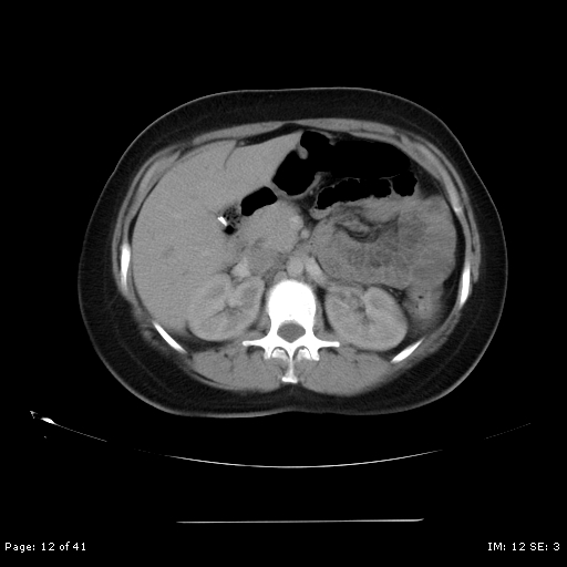 File:Abdominal wall endometriosis (Radiopaedia 25723-25885 Axial C+ portal venous phase 12).jpg