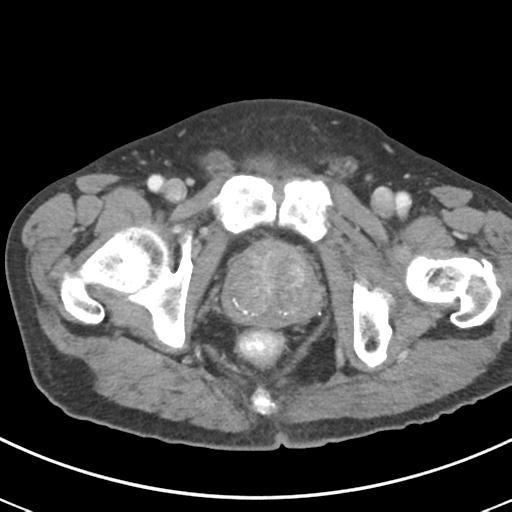 Abdominal wall metastasis from colorectal carcinoma (Radiopaedia 31016-31717 Axial C+ portal venous phase 76).jpg
