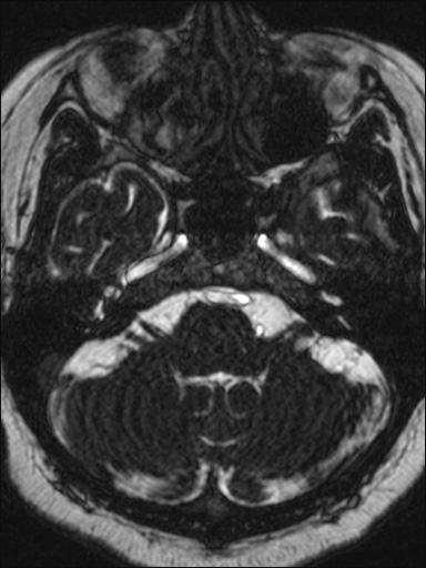 Abducens nerve palsy (Radiopaedia 57084-63976 Axial T2 ciss 3d 20).jpg