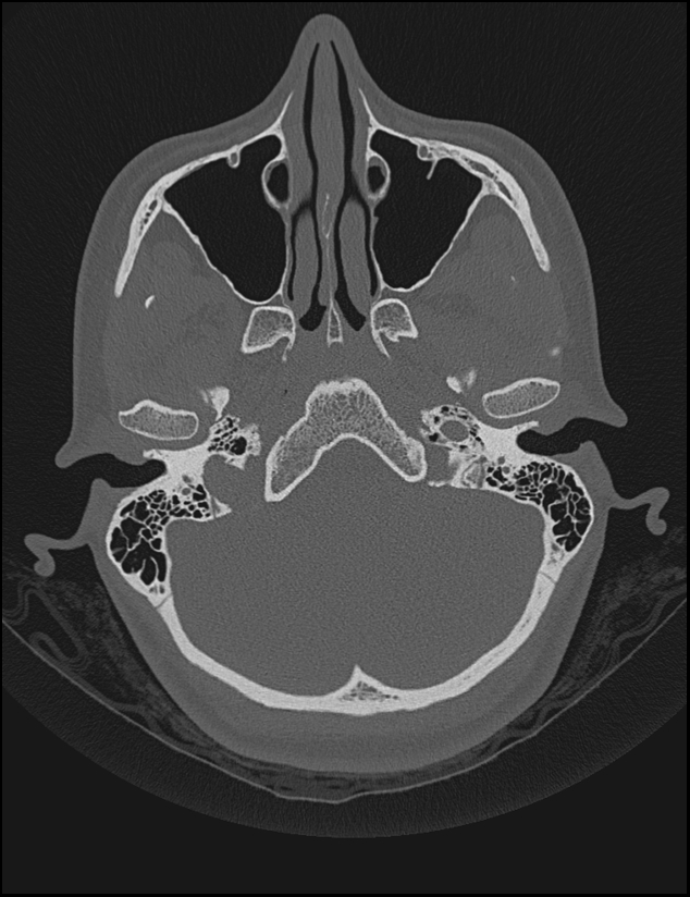 Aberrant right internal carotid artery (Radiopaedia 65191-74198 Axial non-contrast 29).jpg