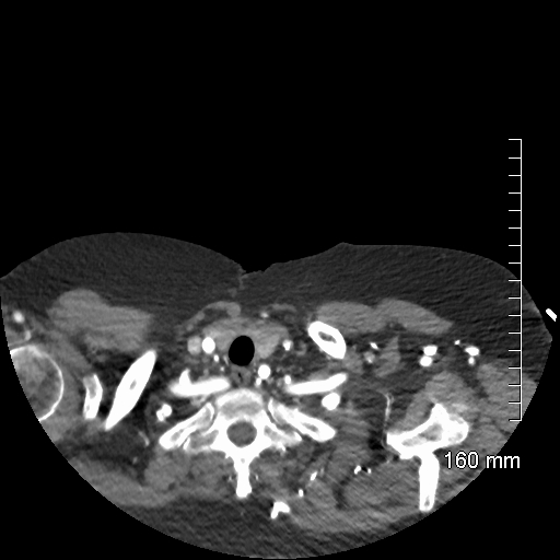 Aberrant right subclavian artery stenosis (Radiopaedia 52656-58670 Axial C+ arterial phase 5).jpg