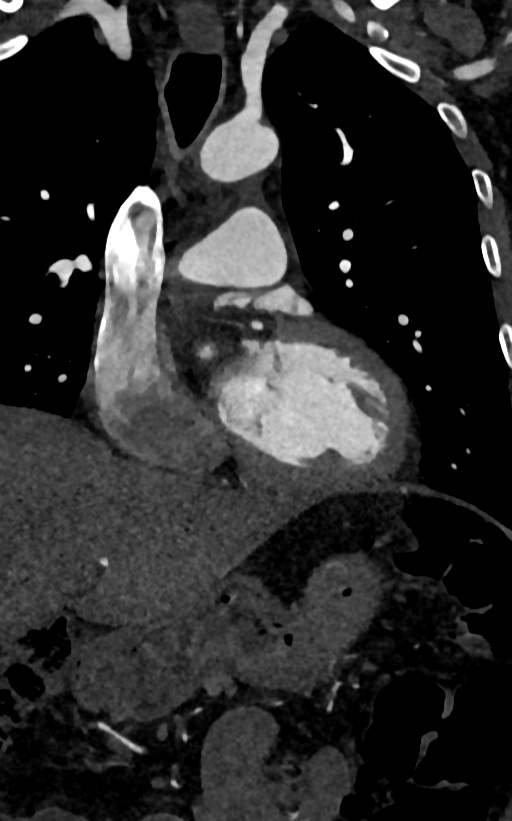 Accessory left atrial appendage (Radiopaedia 81987-95968 Coronal C+ arterial phase 44).jpg