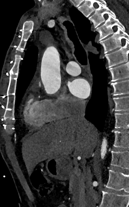 Accessory left atrial appendage (Radiopaedia 81987-95968 Sagittal C+ arterial phase 33).jpg