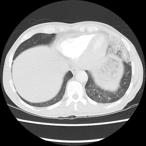 Accessory left horizontal fissure with lingular pneumonia (Radiopaedia 53763-59843 Axial lung window 45).jpg