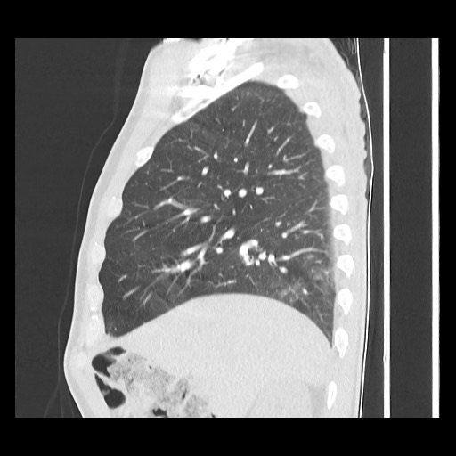 Accessory left horizontal fissure with lingular pneumonia (Radiopaedia 53763-59843 Sagittal lung window 23).jpg