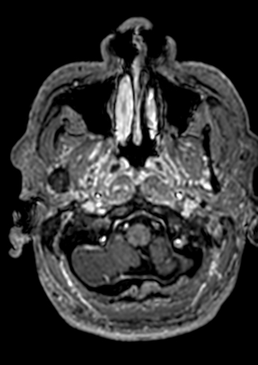 Accessory middle cerebral artery (Radiopaedia 73114-83828 Axial T1 C+ 178).jpg