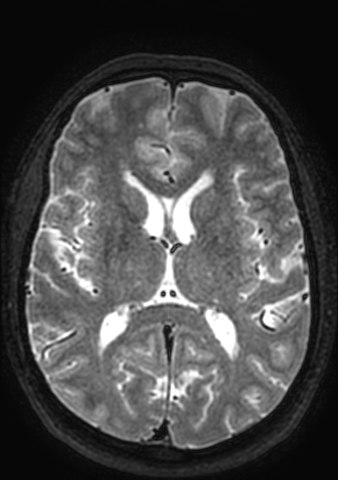 Accessory middle cerebral artery (Radiopaedia 73114-83828 Axial T2 57).jpg