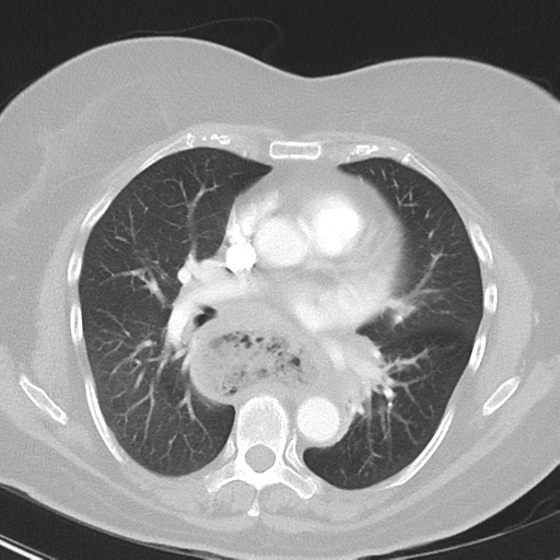 File:Achalasia (Radiopaedia 47147-51685 Axial lung window 26).png