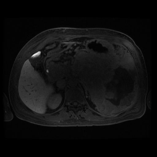 Acinar cell carcinoma of the pancreas (Radiopaedia 75442-86668 Axial late phase (~30 mins) 72).jpg