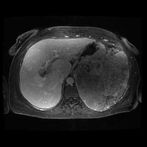 Acinar cell carcinoma of the pancreas (Radiopaedia 75442-86668 D 102).jpg