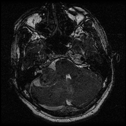 File:Acoustic schwannoma (Radiopaedia 39170-41387 Axial FIESTA 68).png