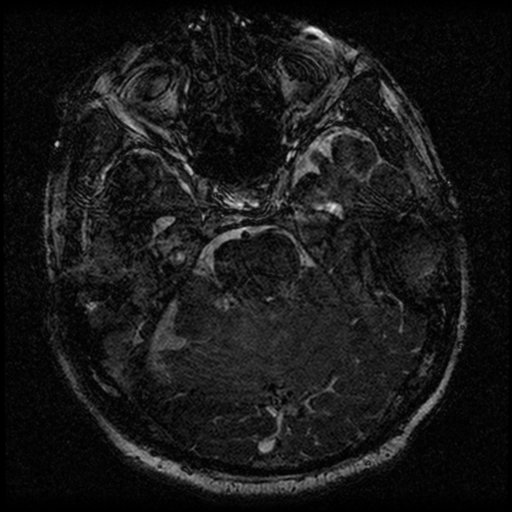 File:Acoustic schwannoma (Radiopaedia 39170-41387 Axial FIESTA 94).png