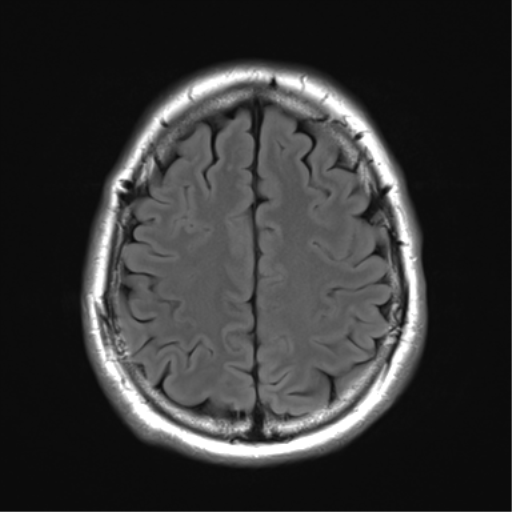 File:Acoustic schwannoma (Radiopaedia 50846-56358 Axial FLAIR 25).png