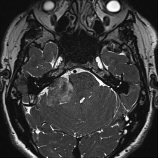 File:Acoustic schwannoma (Radiopaedia 50846-56358 Axial T2 25).png