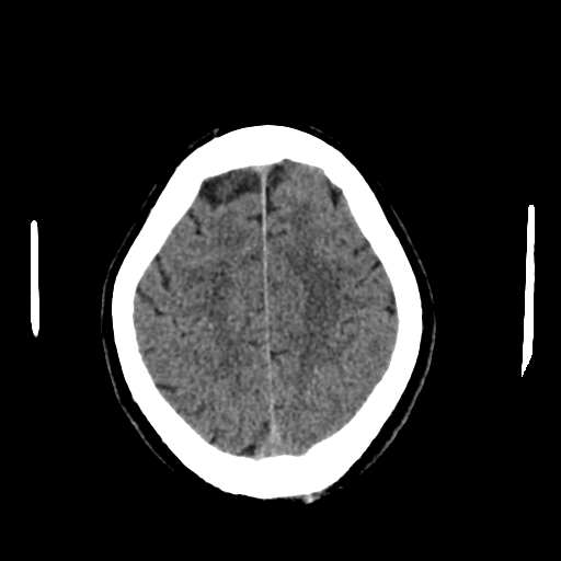 File:Acoustic schwannoma (Radiopaedia 55729-62280 Axial non-contrast 27).png