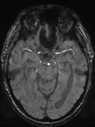 File:Acoustic schwannoma (Radiopaedia 55729-62281 Axial SWI 20).png