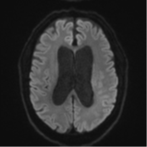 File:Acoustic schwannoma (Radiopaedia 55729-62281 E 44).png