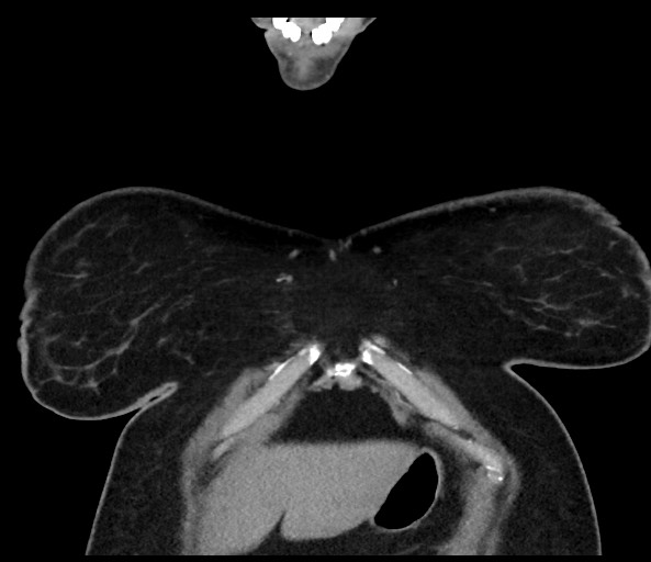 Acromioclavicular joint cyst (Radiopaedia 58455-65610 Coronal C+ arterial phase 23).jpg