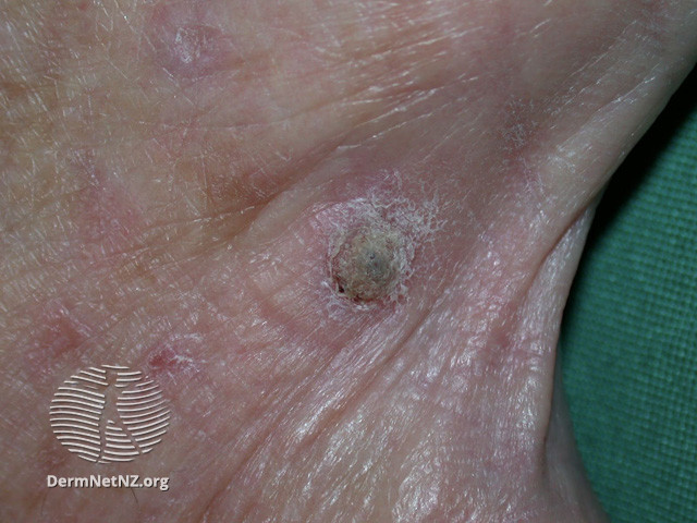 File:Actinic keratoses affecting the hands (DermNet NZ lesions-ak-hands-524).jpg