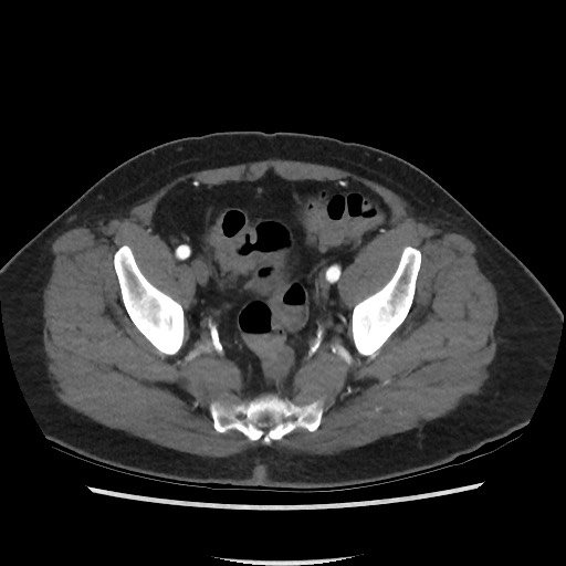 Active colonic bleed on CT (Radiopaedia 49765-55025 Axial C+ arterial phase 70).jpg