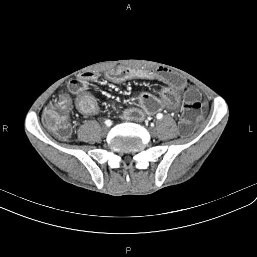 Active crohn disease (Radiopaedia 87133-103397 Axial C+ arterial phase 72).jpg