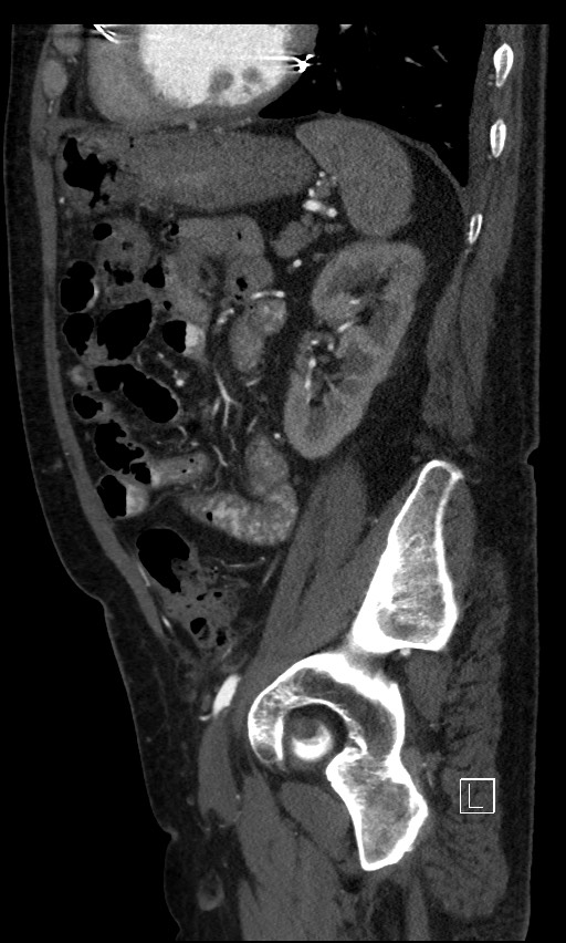 Active lower gastrointestinal bleeding - diverticular (Radiopaedia 61203-69106 Sagittal C+ arterial phase 49).jpg