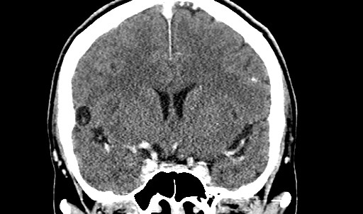 File:Active neurocysticercosis before and after therapy (Radiopaedia 71710-82099 Coronal C+ delayed 34).jpg