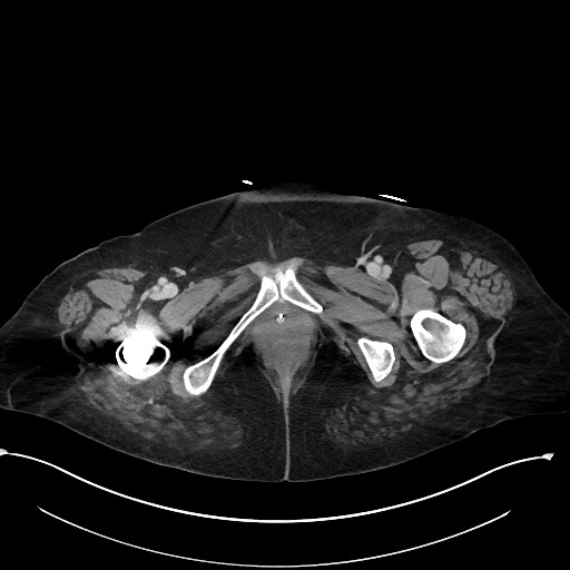 File:Active renal extravasation with large subcapsular and retroperitoneal hemorrhage (Radiopaedia 60975-68796 Axial 348).jpg