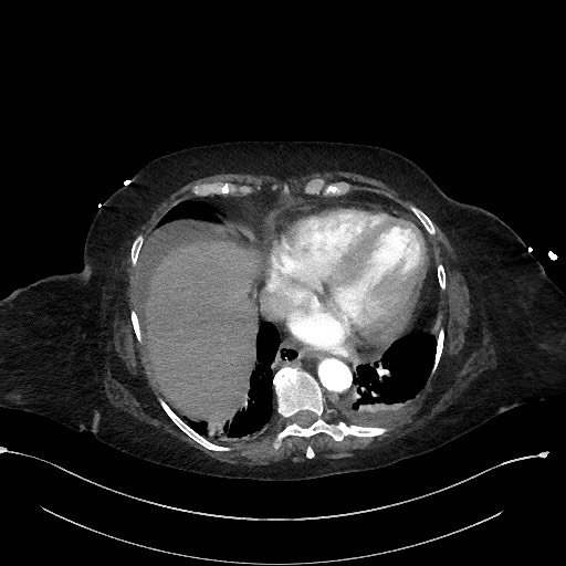 Active renal extravasation with large subcapsular and retroperitoneal hemorrhage (Radiopaedia 60975-68796 Axial C+ arterial phase 22).jpg