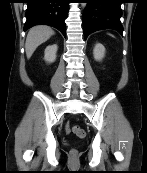 Acute-on-chronic pancreatitis (Radiopaedia 67286-76656 Coronal C+ portal venous phase 54).jpg