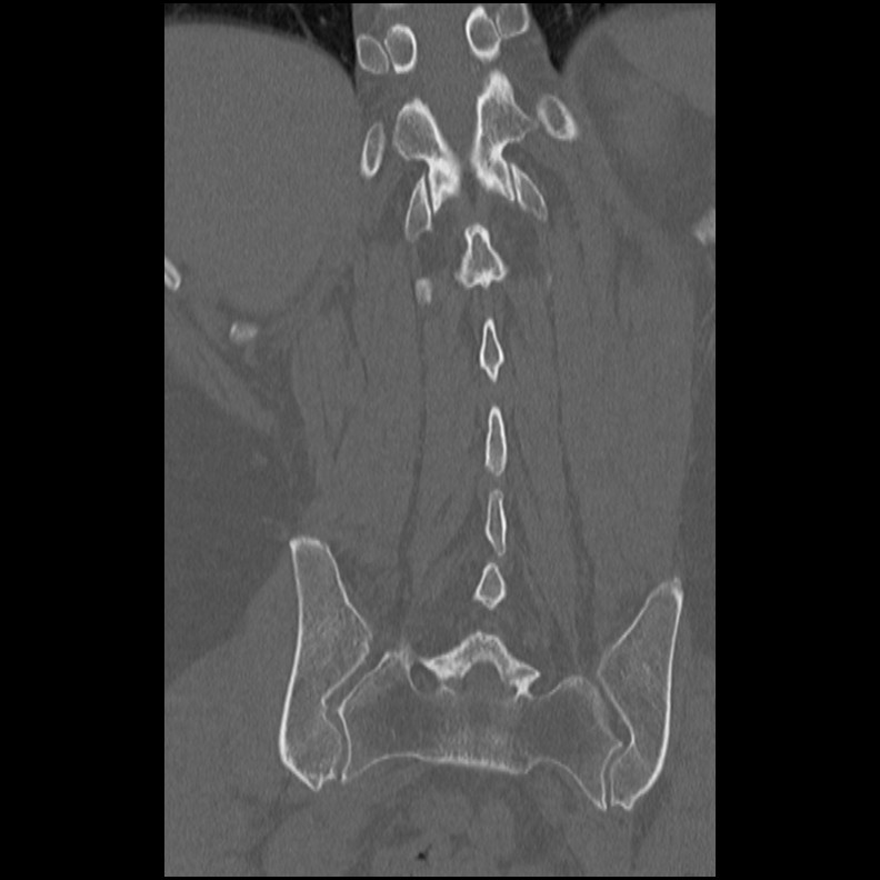 Acute Schmorl's node (Radiopaedia 83276-102365 Coronal bone window 44).jpg