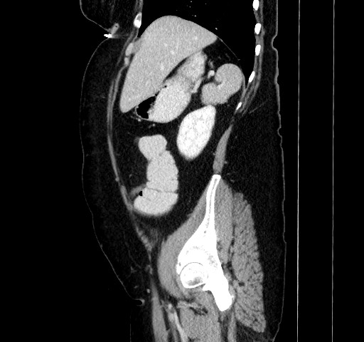Acute appendicitis, heterotaxy syndrome (Radiopaedia 66884-76202 Sagittal C+ portal venous phase 41).jpg