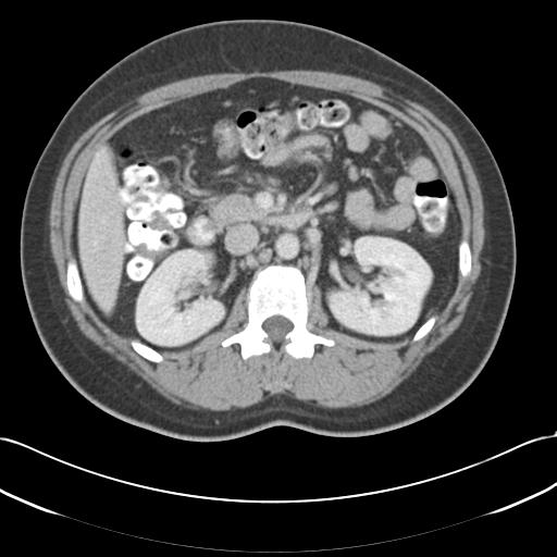 Acute appendicitis (Radiopaedia 30297-30934 Axial C+ portal venous phase 31).jpg