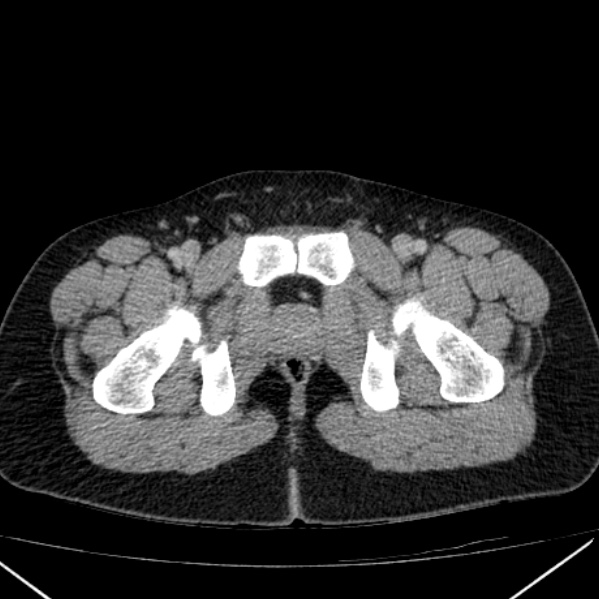 Acute appendicitis (Radiopaedia 38255-40270 Axial C+ portal venous phase 114).jpg