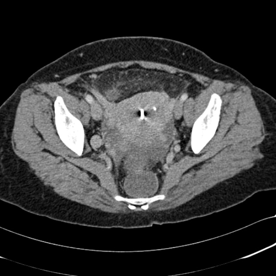 Acute appendicitis (Radiopaedia 48792-53822 Axial C+ portal venous phase 101).jpg
