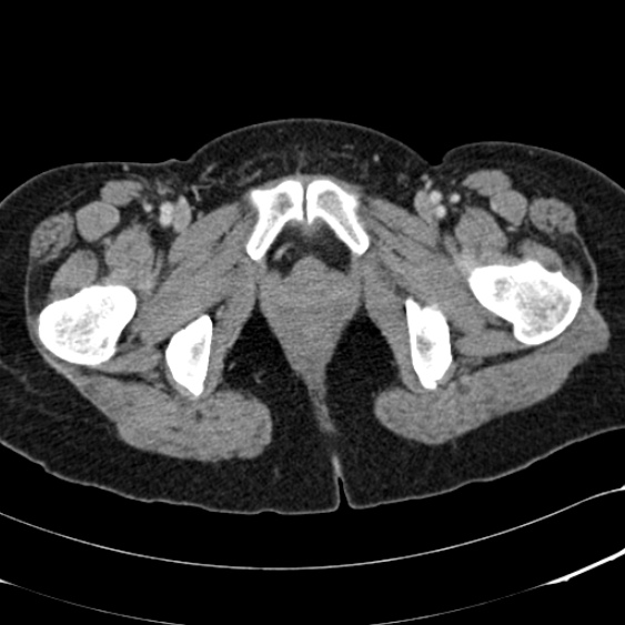 File:Acute appendicitis (Radiopaedia 48792-53822 Axial C+ portal venous phase 122).jpg