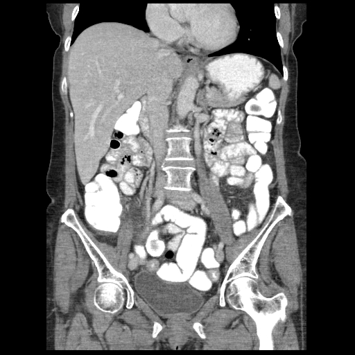 Acute appendicitis (Radiopaedia 52672-58589 Coronal C+ portal venous phase 53).jpg