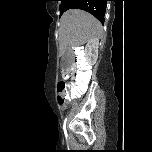 File:Acute appendicitis (Radiopaedia 52672-58589 Sagittal C+ arterial phase 29).jpg