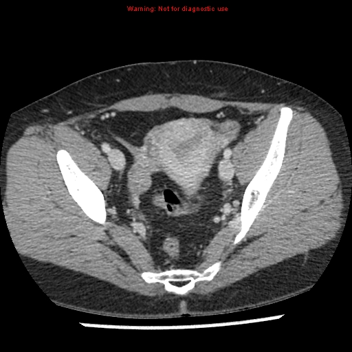 File:Acute appendicitis (Radiopaedia 7966-8812 C+ portal venous phase 46).jpg