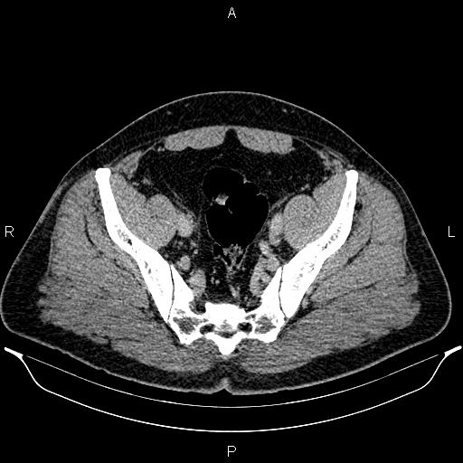 Acute appendicitis (Radiopaedia 84780-100240 Axial C+ portal venous phase 90).jpg