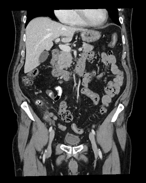 Acute appendicitis - large appendicoliths (Radiopaedia 61805-69820 Coronal C+ portal venous phase 57).jpg