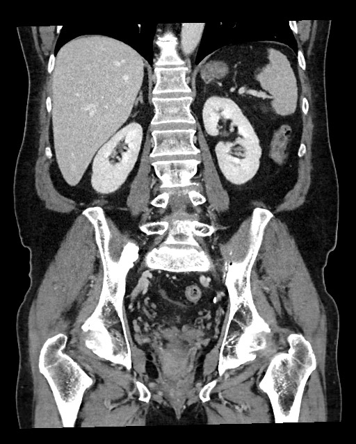 Acute appendicitis - large appendicoliths (Radiopaedia 61805-69820 Coronal C+ portal venous phase 89).jpg